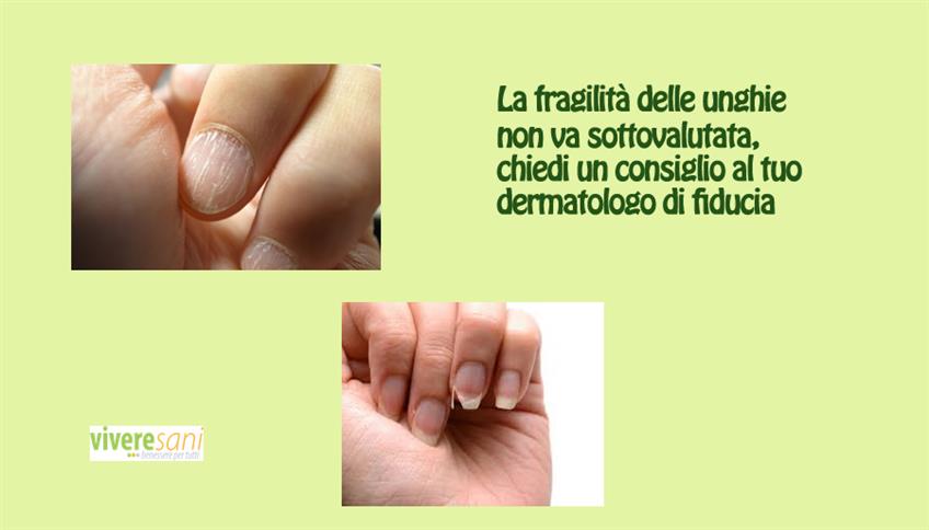 Fragilità delle unghie Fragilità delle unghie